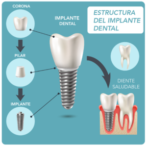 Implante Dental-01